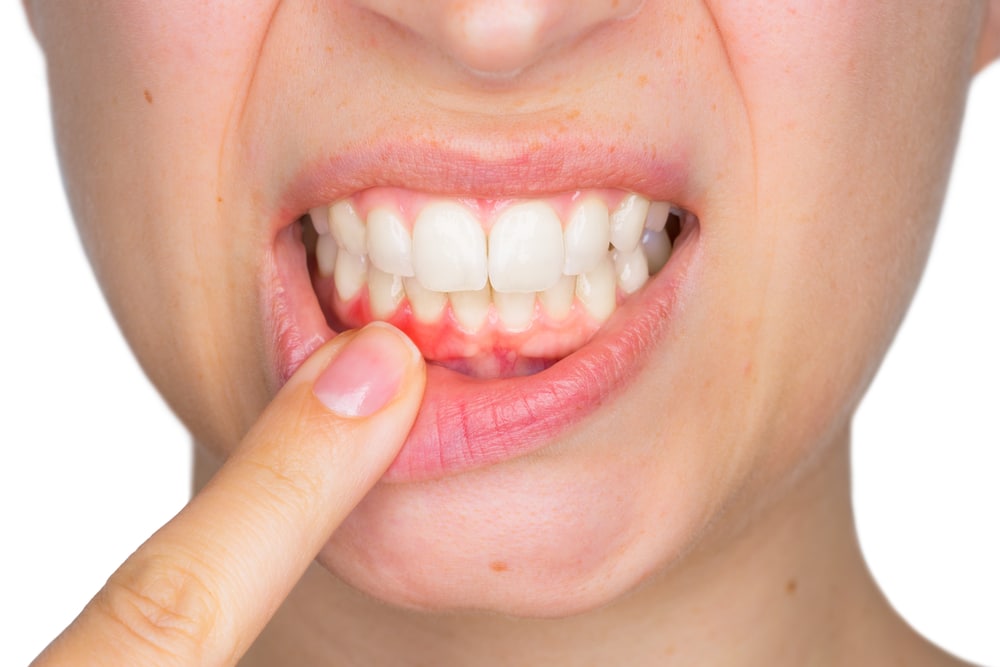 The Cons of Gum Disease and when to get treated dr. scott chandler dmd Dentist in Park City, UT