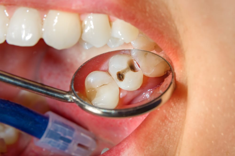 What are Cavities? dr. scott chandler dmd Dentist in Park City, UT