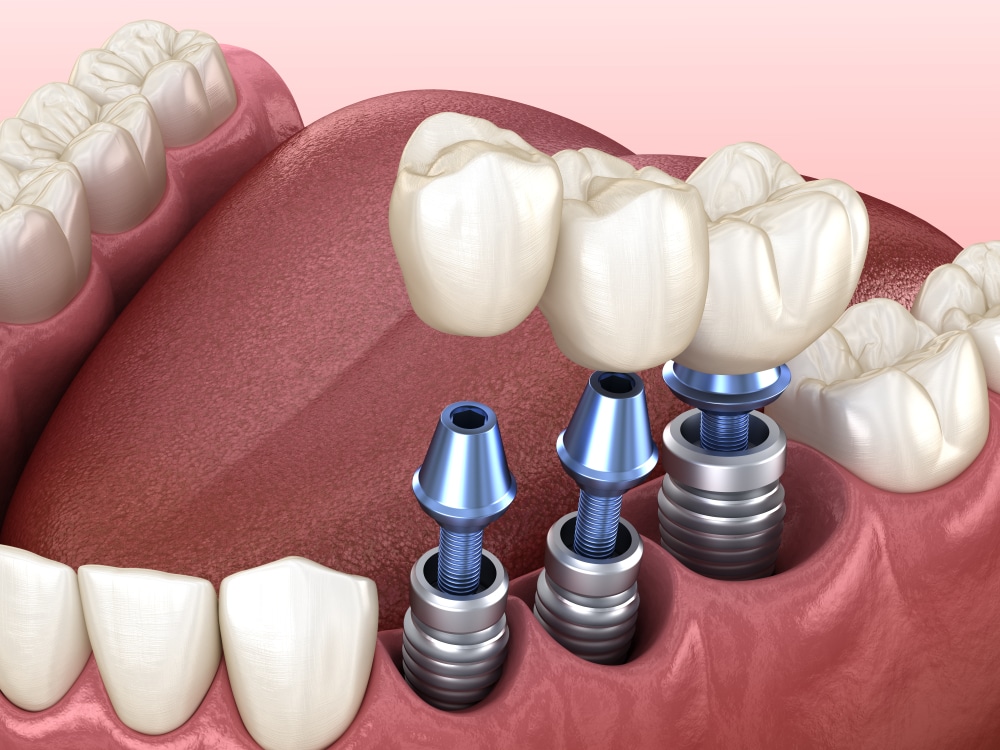 dental implants vs dentures dr. scott chandler dmd Dentist in Park City, UT